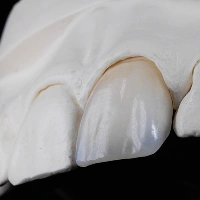 セラミック矯正