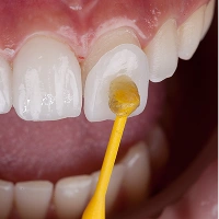 ラミネートベニア