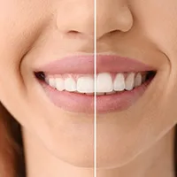 ガミースマイル治療