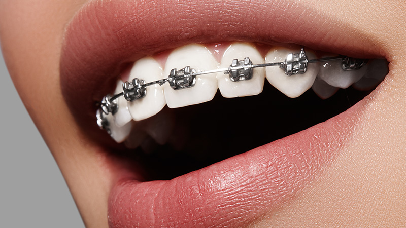 コルチコトミー矯正