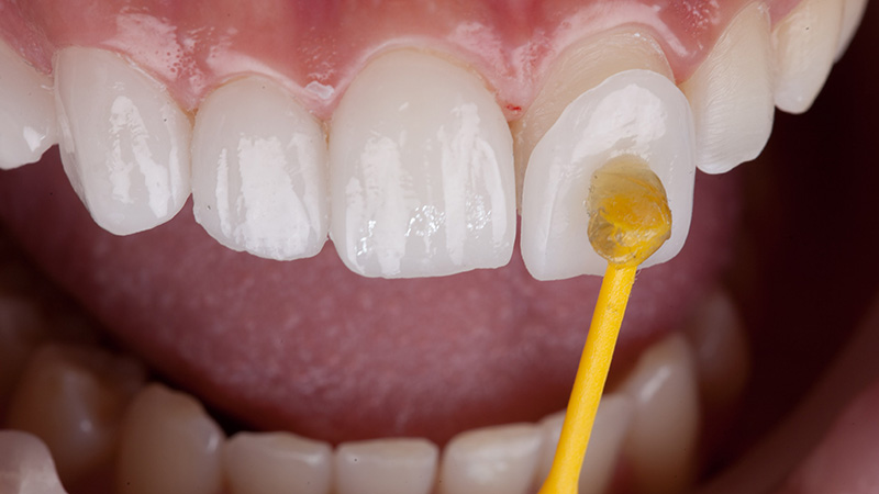 ラミネートベニア