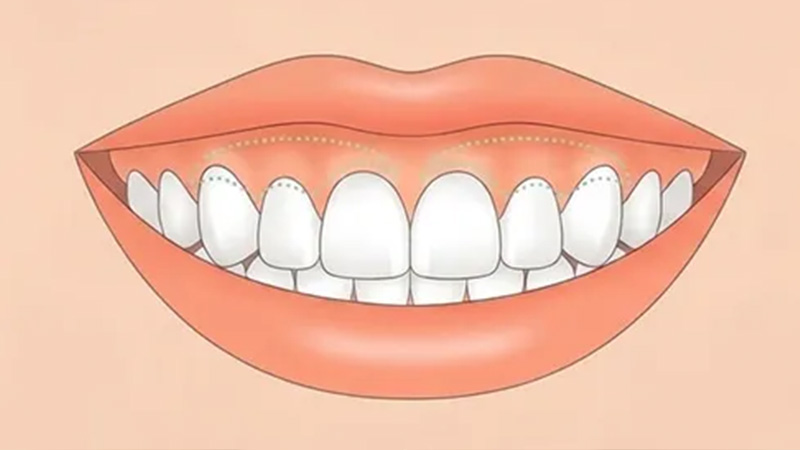 ガミースマイル治療