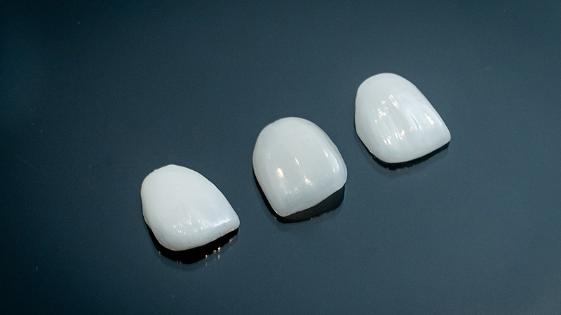 セラミック治療のイメージ