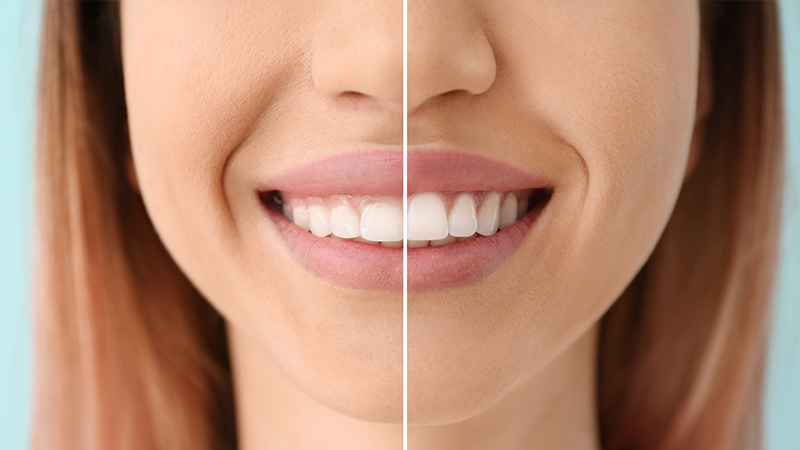 ガミースマイルの施術イメージ