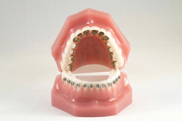 ハーフリンガル矯正