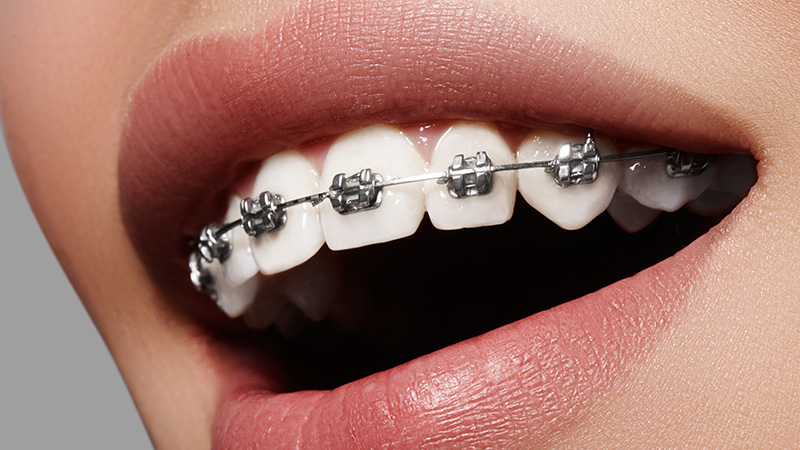 メタルブラケット