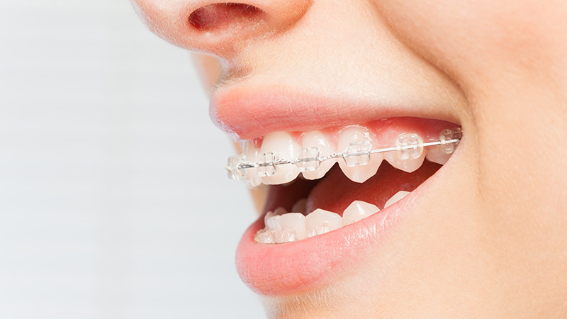 セラミックブラケット