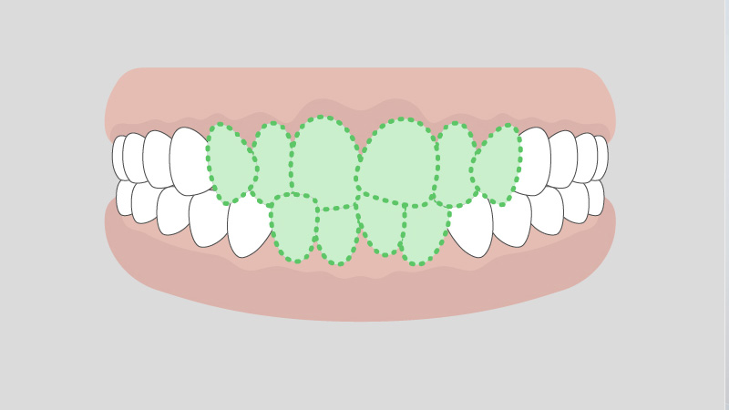 叢生（がたがた歯並び）の例