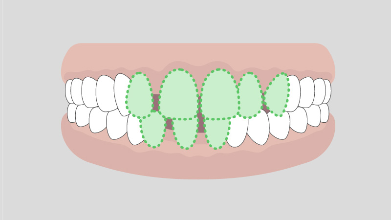 すきっ歯（空隙歯列）の例