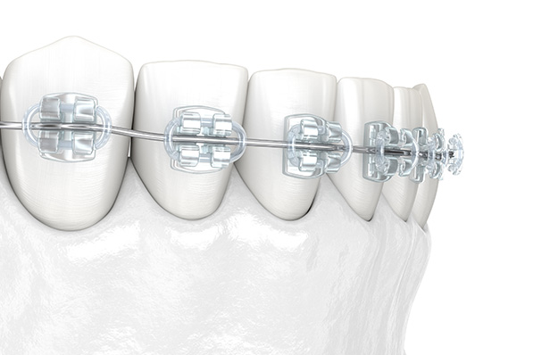 部分矯正（前歯だけの調整）