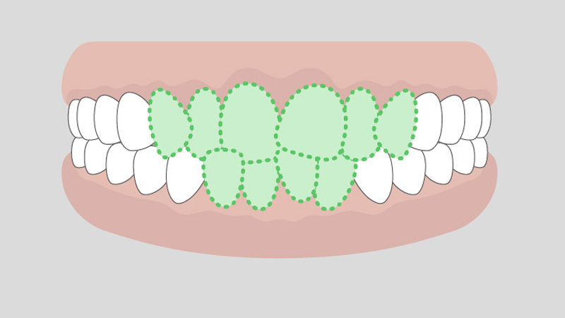 叢生（がたがた）