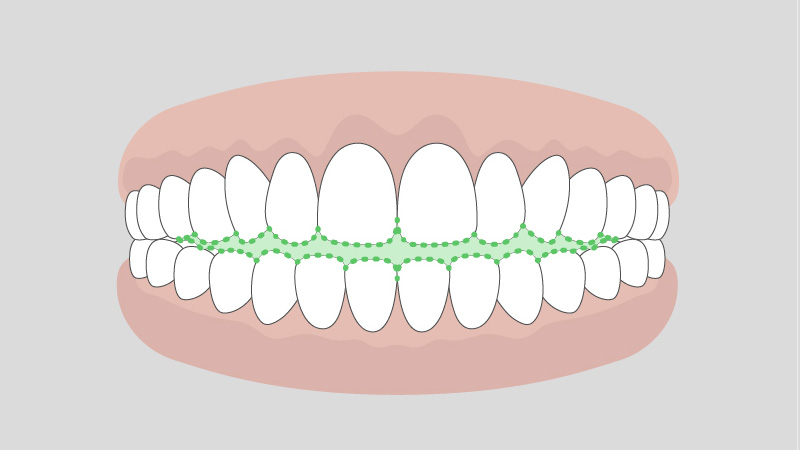開咬（オープンバイト）の状態