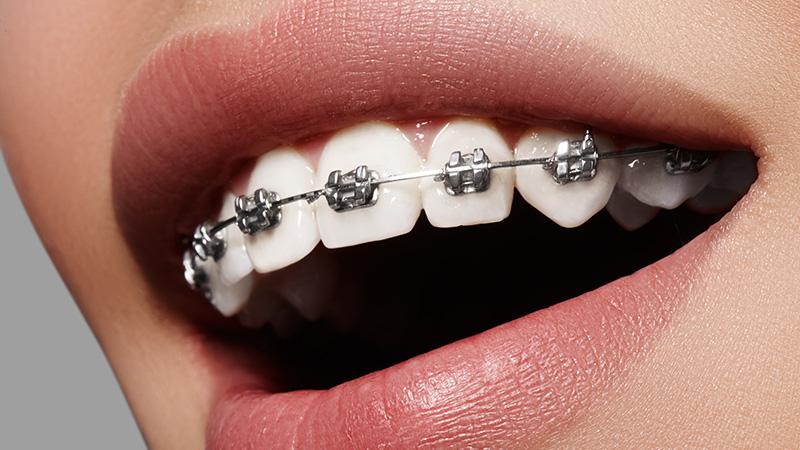 マウスピース型矯正装置のイメージ