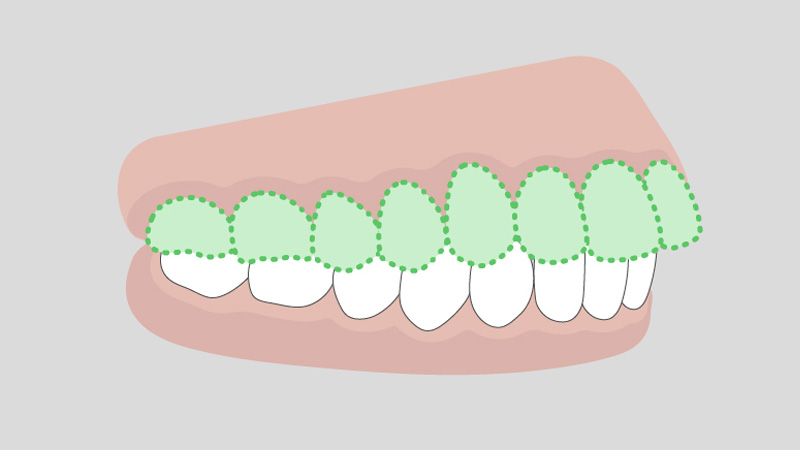 出っ歯（上顎前突）の例