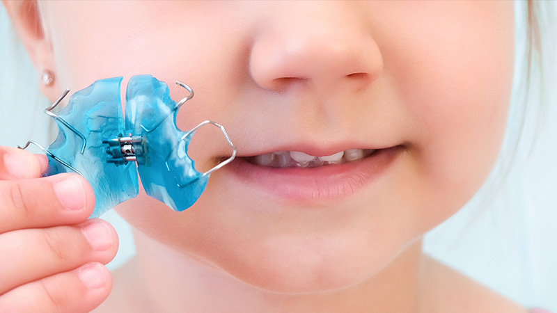 子どもが機能的矯正装置を装着している様子