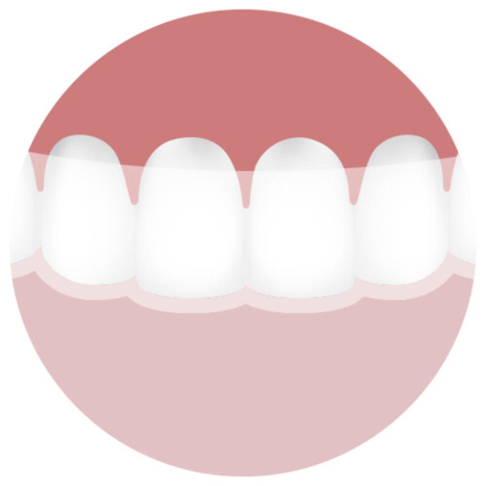 クリアアライナー（マウスピース型矯正装置）のイラスト