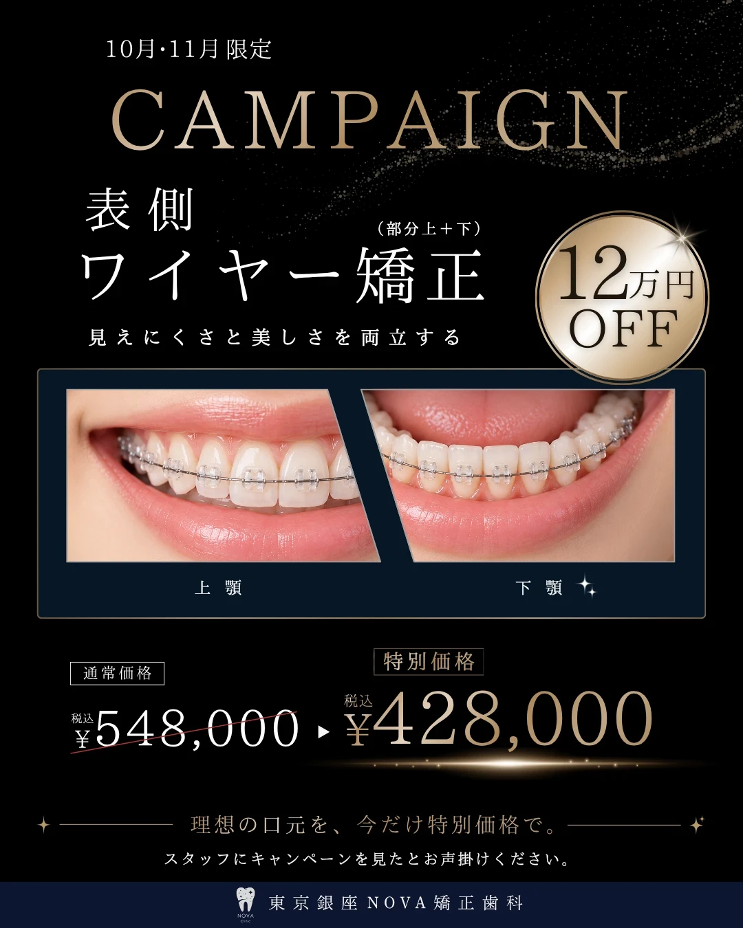 表側ワイヤー矯正（部分 上＋下）12万円OFF